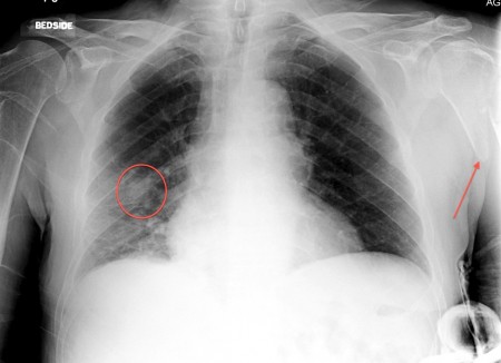 Lung cancer with bone metastasis