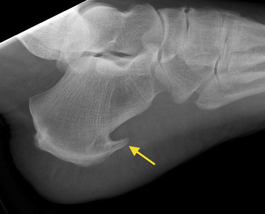 plantar calcaneal spur images