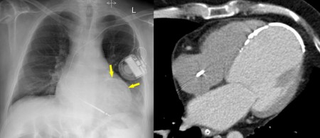 Calcified ventricular aneurysm