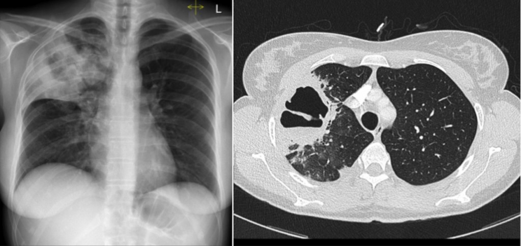 Cavitating pneumonia - Radiology at St. Vincent's University Hospital