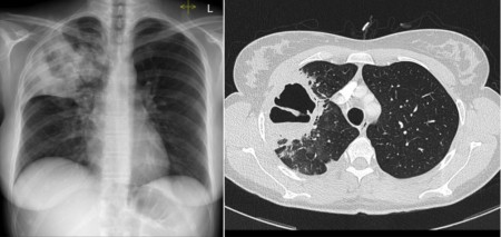 Cavitating pneumonia