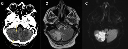 Cerebellar infarct