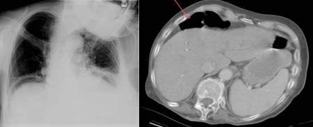 Chilaiditi Syndrome – CXR and CT