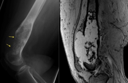 Chondrosarcoma