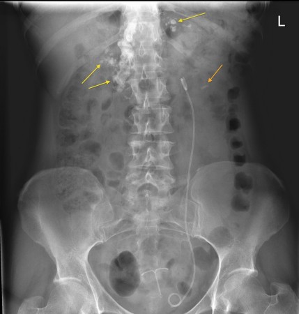 Chronic pancreatitis – PFA