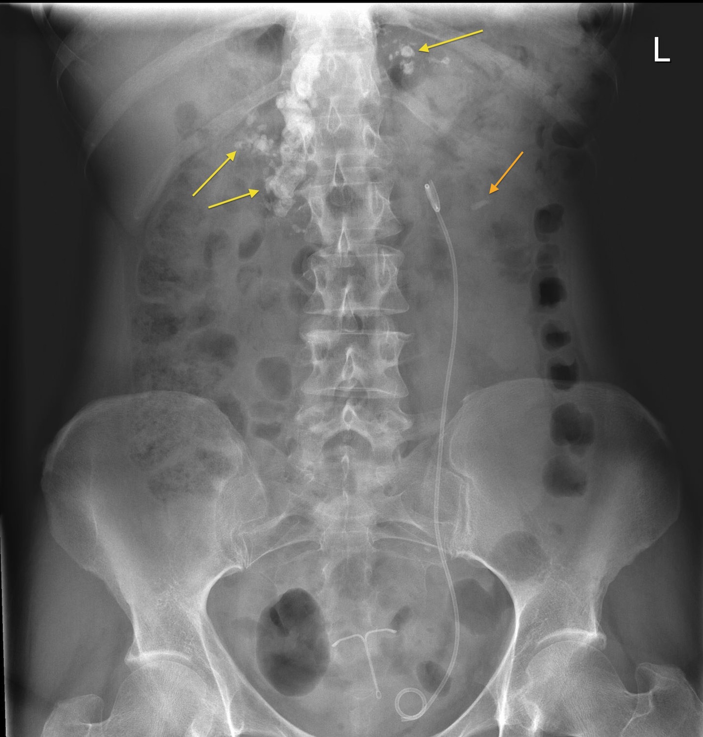 Chronic pancreatitis – PFA - Radiology at St. Vincent's University Hospital