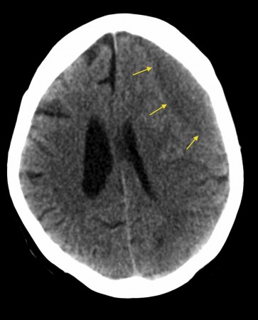 Chronic subdural haematoma