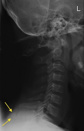 Clay shoveler’s fracture