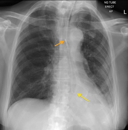 NG tube coiled in oesophagus