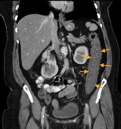 Colitis – CT