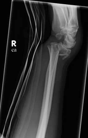 Colles fracture