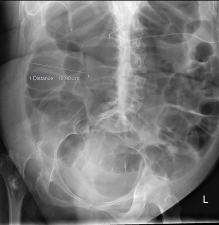 Paralytic ileus