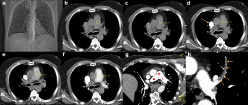 These images illustrate the steps involved in performing a CT pulmonary angiogram. (a) is the scout image; this is performed first and is used to select the 'range' of the CT - in this case, the radiographer will start the range at the lung apices and finish at the diaphragms. (b) A non-contrast CT slice is obtained at the level of the main pulmonary artery, and a circular 'region of interest' (ROI) is placed over the artery by the radiographer. The IV contrast pump is started, following which the scanner takes a single image through the pulmonary artery every 2 seconds, measuring the density each time. On (c), the density is +4 Hounsfield Units (HU). On (d) you can see the contrast arriving into the SVC (arrow). By the next image, (e), the density in the ROI has reached +51 HU, while on (f) it is 123 HU. This is above the threshold set to initiate the CT, therefore the scan is performed. (g) shows the excellent enhancement of the main (M), right (R) and left (L) pulmonary arteries while (h) shows a large filling defect, representing a PE, in the left upper lobe artery (arrows).