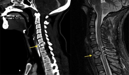 Cervical burst fracture