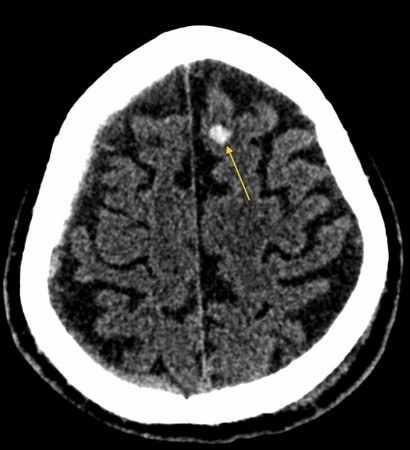 Cerebral contusion