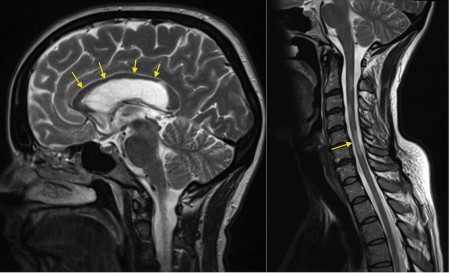 Multiple sclerosis – spinal cord atrophy