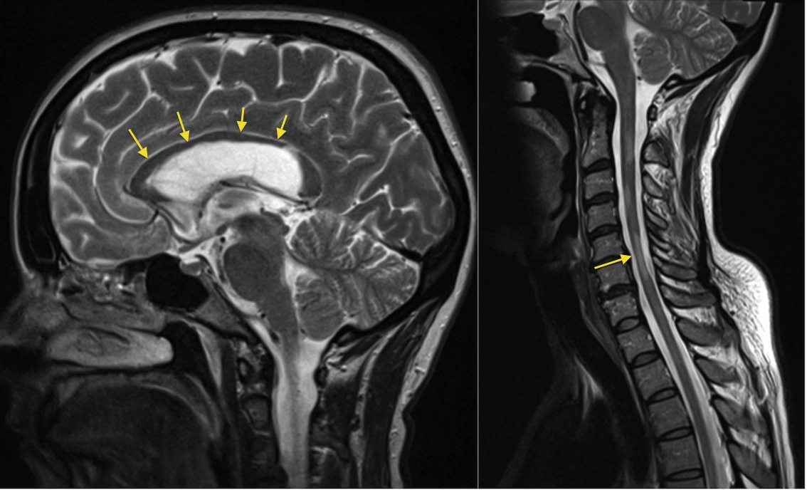 Multiple sclerosis - spinal cord atrophy - Radiology at St. Vincent's