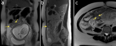 Crohn disease – MRI