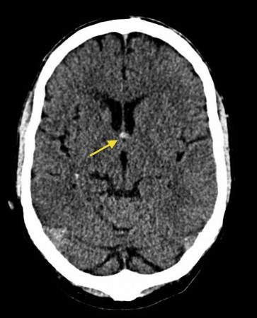 Colloid cyst