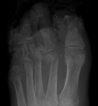 Osteomyelitis in diabetic foot