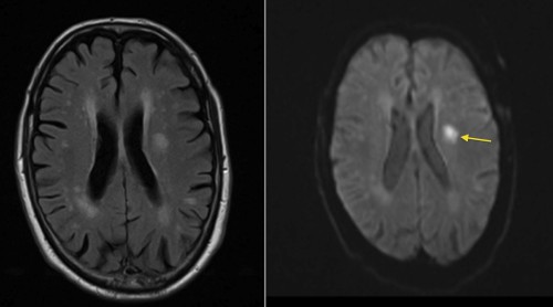This patient presented with right-sided weakness. The left image is a FLAIR image (see below), and shows multiple areas of abnormal high signal in both cerebral hemispheres. These are all consistent with ischaemic changes - but could all be old. The DWI image on the right helps us by indicating that one of the lesions in the left frontal lobe shows restricted diffusion (arrow) and is therefore an acute infarct. 