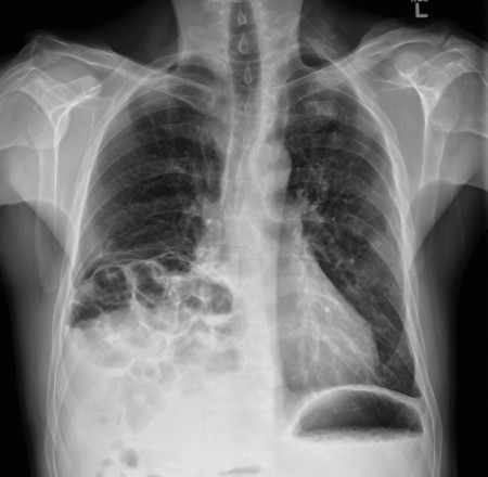 Diaphragmatic hernia