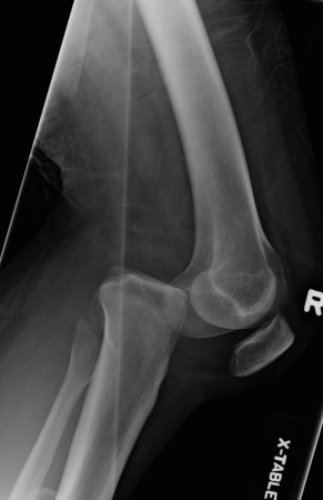Posterior knee dislocation