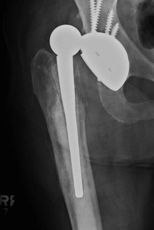 Dislocated hip prosthesis