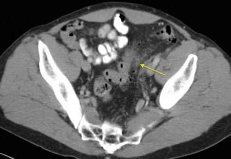 Acute Diverticulitis