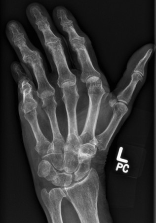 Dupeytren’s contracture