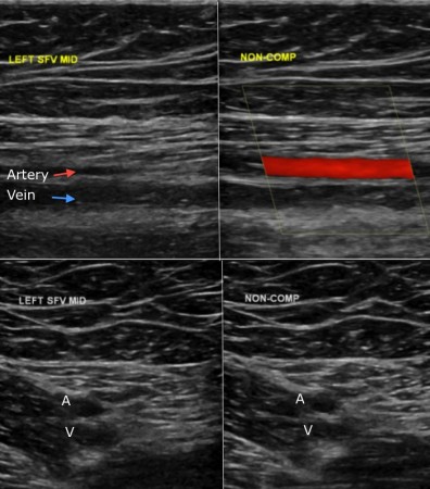 Deep venous thrombosis