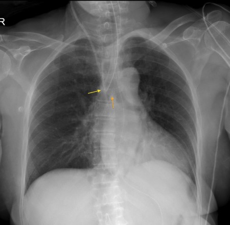 Endotracheal tube at carina