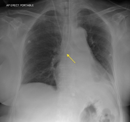 Malpositioned endotracheal tube