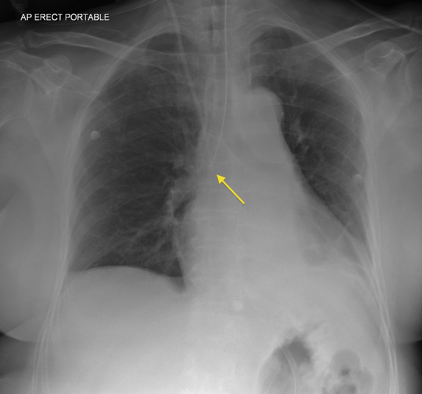 Malpositioned endotracheal tube Radiology at St. Vincent's University