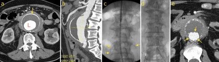 Endovascular aneurysm repair (EVAR)