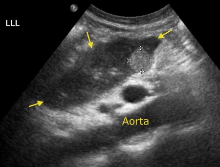 Liver metastasis – US