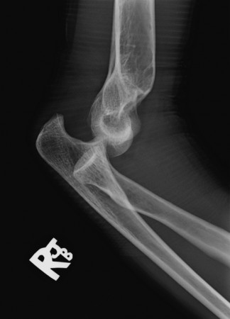 Elbow dislocation - Radiology at St. Vincent's University Hospital