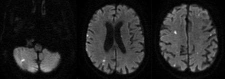 Embolic infarcts