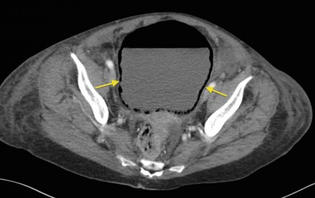 Emphysematous cystitis