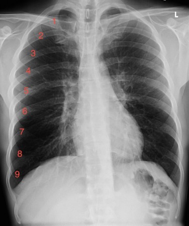 Emphysema