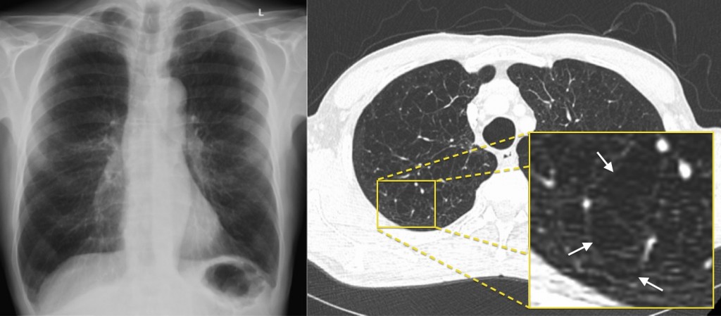 Emphysema – CT - Radiology at St. Vincent's University Hospital