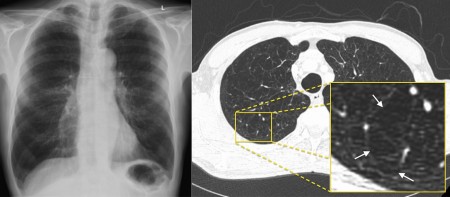 Emphysema – CT