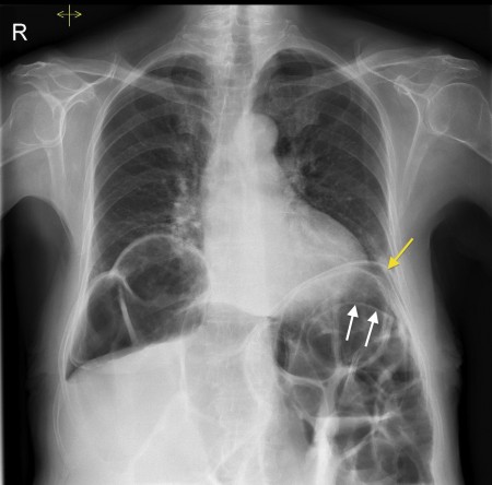 Chilaiditi’s syndrome with perforation