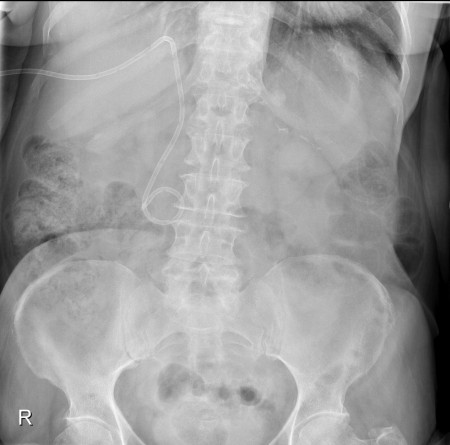 Biliary drainage catheter