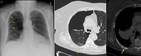Pneumothorax and rib fractures – CXR and CT