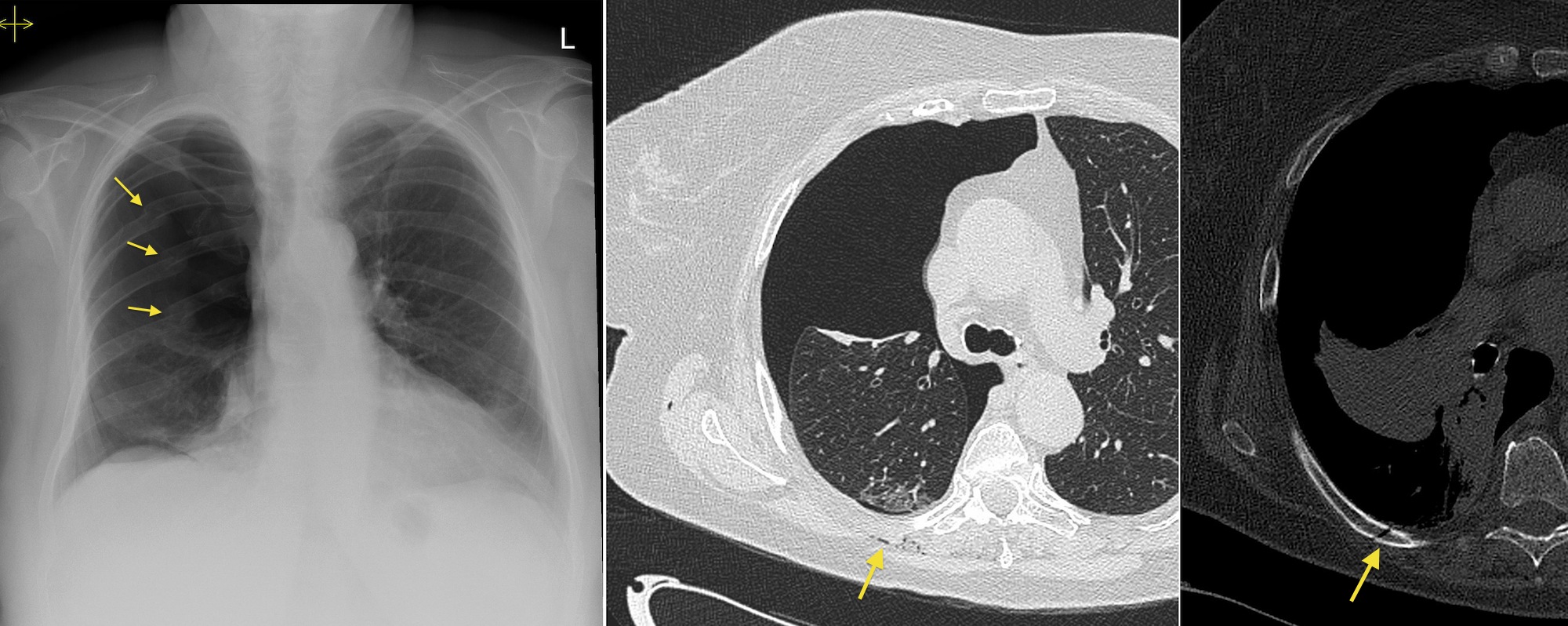 Pneumothorax And Rib Fractures Cxr And Ct Radiology At St Vincent