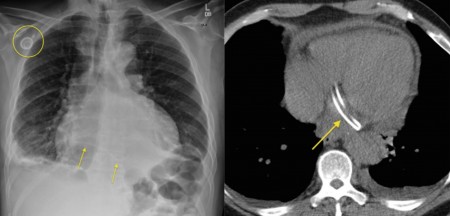 Fractured central venous catheter