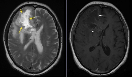 Glioblastoma multiforme