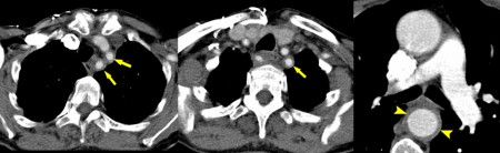 Giant Cell Arteritis – CT