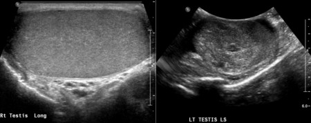 Testicular tumour